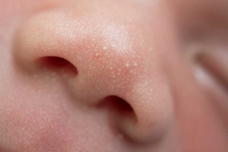 How To Treat Baby Rashes At Home Tips And Remedies 