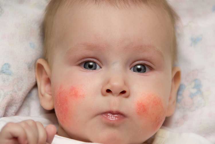 How To Treat Baby Rashes At Home Tips And Remedies 